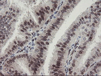 ab128081 at 1/150 dilution staining RBPMS in Paraffin-embedded Human endometrium adenocarcinoma tissue by Immunohistochemistry.