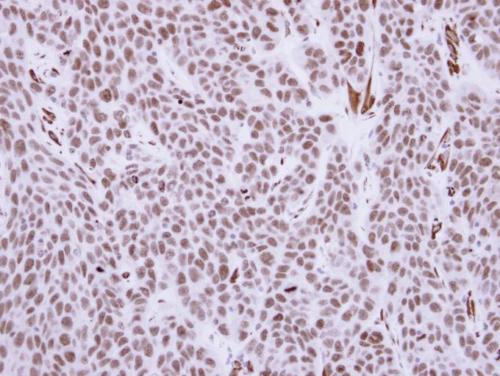 Immunohistochemical analysis of paraffin-embedded Human KYSE170 xenograft tissue, staining RCC1 using ab152156 at a 1/500 dilution.