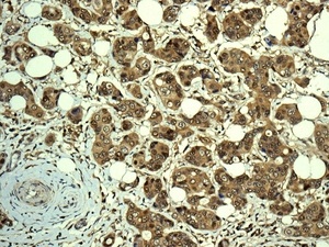 Immunohistochemical analysis of paraffin embedded Human breast carcinoma tissue labelling RCL with ab150413 antibody at a dilution of 1/100.