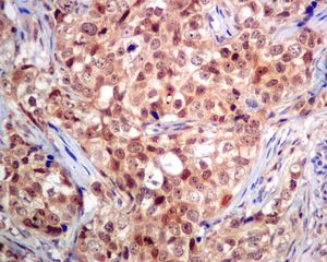 Immunohistochemical analysis of paraffin embedded Human breast carcinoma tissue labelling RCL with ab131252 antibody at 1/100 dilution.