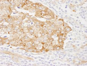 ab84450, at 1/250 dilution, staining RCN1 in formalin-fixed, paraffin-embedded human breast carcinoma by Immunohistochemistry using DAB detection.