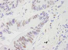 Detection of Human RECQ1 by Immunohistochemistry.Sample: formalin fixed, paraffin embedded section of human lung adenocarcinoma.Antibody: ab84437 used at a dilution of 1/250.Detection: DAB staining.