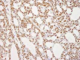 Detection of Human RECQ1 by Immunohistochemistry.Sample: formalin fixed, paraffin embedded section of human basal cell carcinoma.Antibody: ab84437 used at a dilution of 1/250.Detection: DAB staining.