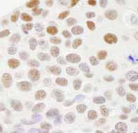Detection of Human RECQ1 by Immunohistochemistry.Sample: formalin fixed, paraffin embedded section of human breast adenocarcinoma.Antibody: ab84437 used at a dilution of 1/250.Detection: DAB staining.