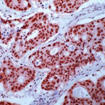 ab15519 staining Retinoid X Receptor gamma in Human prostate carcinoma tissue by Immunohistochemistry (Formalin/PFA-fixed paraffin-embedded sections).