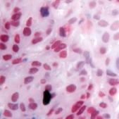 ab15519 staining Retinoid X Receptor gamma in breast carcinoma by Immunohistochemistry (Formalin/PFA-fixed paraffin-embedded sections).