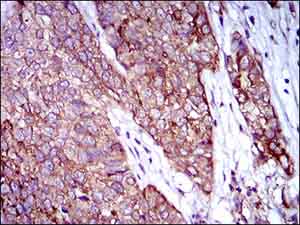 Immunohistochemical analysis of paraffin-embedded human bladder cancer tissue labeling Rex1 with ab175429 at 1/200 dilution, with DAB staining.