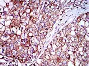 Immunohistochemical analysis of paraffin-embedded human lung cancer tissue labeling Rex1 with ab175429 at 1/200 dilution, with DAB staining.