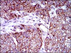 Immunohistochemical analysis of paraffin-embedded Human esophagus cancer tissue labeling Rex1 with ab175431 at 1/200 dilution with DAB staining.