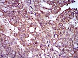 Immunohistochemical analysis of paraffin-embedded Human rectum cancer tissue labeling Rex1 with ab175431 at 1/200 dilution with DAB staining.