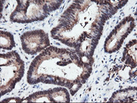 ab128090 at 1/150 dilution staining RFPL3 in Paraffin-embedded Human Colon adenocarcinoma tissue by Immunohistochemistry.
