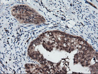 ab128090 at 1/150 dilution staining RFPL3 in Paraffin-embedded Human Endometrium adenocarcinoma tissue by Immunohistochemistry.