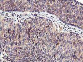 Immunohistochemical staining of paraffin-embedded carcinoma of Human bladder tissue using 1/150 ab119432.