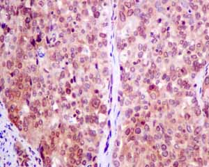 Immunohistochemical analysis of paraffin embedded Human cervical carcinoma tissue using ab154172 showing +ve staining.