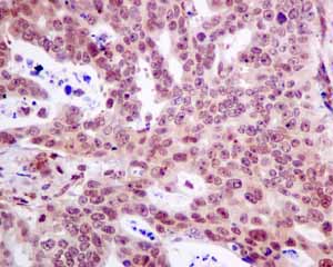 Immunohistochemical analysis of paraffin embedded Human gastric adenocarcinoma tissue using ab154172 showing +ve staining.