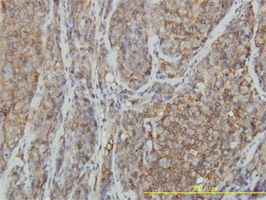RhoA antibody (ab54835) used in immunohistochemistry at 5ug/ml on formalin fixed and paraffin embedded human lymphoma tissue.