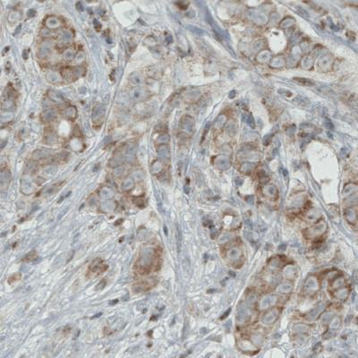 Immunohistochemical analysis of paraffin-embedded Human breast cancer tissue, labeling Rhot1 using ab188029 at a 1/200 dilution.