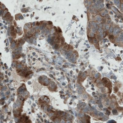 Immunohistochemical analysis of paraffin-embedded Human stomach cancer tissue, labeling Rhot1 using ab188029 at a 1/200 dilution.