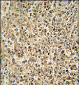 ab107313, at a 1/50 dilution, staining Ribonuclease T2 in formalin fixed, paraffin embedded Human spleen carcinoma by Immunohistochemistry, followed by peroxidase conjugation of the secondary antibody and DAB staining.