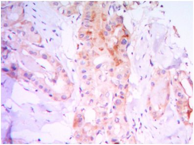 ab104838 at 1/200 dilution staining RICTOR in paraffin-embedded thyroid gland tissues by Immunohistochemistry (Formalin/PFA-fixed paraffin-embedded sections).