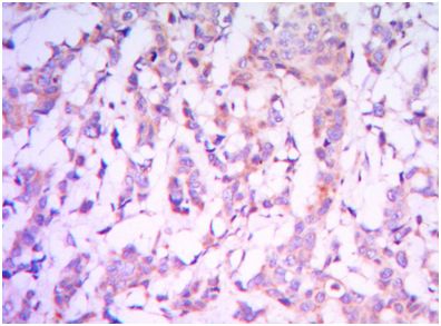 ab104838 at 1/200 dilution staining RICTOR in paraffin-fixed Human breast carcinoma by Immunohistochemistry (Formalin/PFA-fixed paraffin-embedded sections).