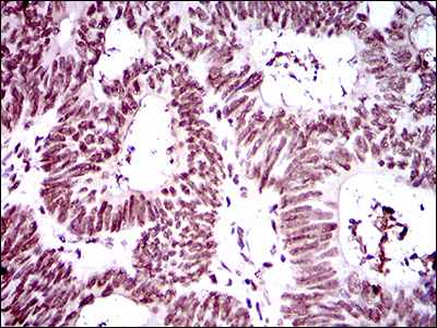 Immunohistochemical analysis of paraffin embedded Human rectum carcinoma tissue labeling RING1 with ab175149 at 1/200 followed by DAB staining.