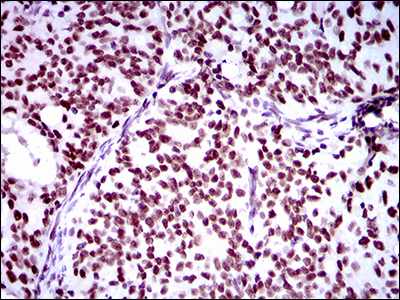Immunohistochemical analysis of paraffin embedded Human cervical carcinoma tissue labeling RING1 with ab175149 at 1/200 followed by DAB staining.
