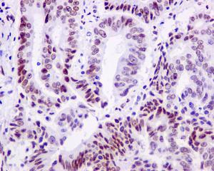 Immunohistochemical analysis of paraffin-embedded Human endometrial carcinoma tissue labeling RING1 using ab180170 at 1/50 dilution.
