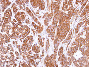 Immunohistochemical analysis of paraffin-embedded A549 xenograft tissue labeling RIP3 with ab152130 at 1/500 dilution.