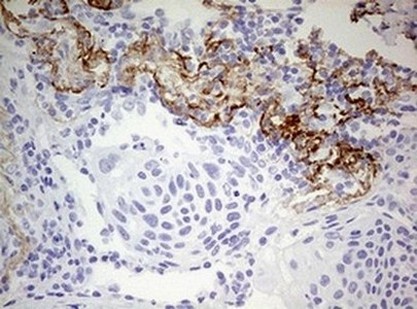 Immunohistochemical analysis of paraffin embedded Human lung carcinoma tissue labeling RIP3 with ab180535 at 1/150 dilution.