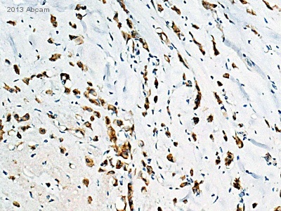 ab122969 staining Nicastrin in Human breast carcinoma tissue sections by Immunohistochemistry (IHC-P - paraformaldehyde-fixed, paraffin-embedded sections). Tissue was fixed with formaldehyde and blocked with 1% BSA for 10 minutes at 21°C; antigen retrieval was by heat mediation in a citrate buffer. Samples were incubated with primary antibody (1/8000 in TBS/BSA/azide) for 16 hours at 21°C. A Biotin-conjugated Goat anti-rabbit IgG polyclonal (1/250) was used as the secondary antibody.See Abreview