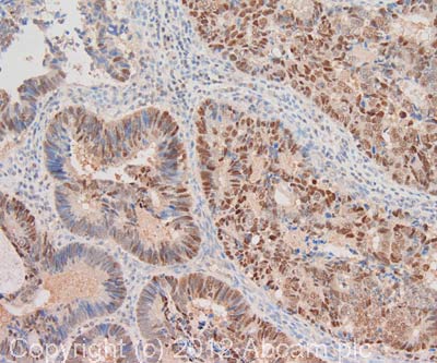 IHC image of RNase H2 subunit C staining in human colon adenocarcinoma formalin fixed paraffin embedded tissue section, performed on a Leica BondTM system using the standard protocol F. The section was pre-treated using heat mediated antigen retrieval with sodium citrate buffer (pH6, epitope retrieval solution 1) for 20 mins. The section was then incubated with ab89726, 1µg/ml, for 15 mins at room temperature and detected using an HRP conjugated compact polymer system. DAB was used as the chromogen. The section was then counterstained with haematoxylin and mounted with DPX. For other IHC staining systems (automated and non-automated) customers should optimize variable parameters such as antigen retrieval conditions, primary antibody concentration and antibody incubation times.