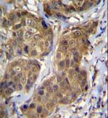 Immunohistochemistry analysis in formalin fixed and paraffin embedded Human breast carcinoma labeling RNF11 with ab171385 at 1/10 dilution followed by peroxidase conjugation of the secondary antibody and DAB staining.