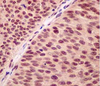 Immunohistochemical analysis of paraffin embedded Human transitional cell carcinoma of bladder tissue labeling RNF7 withab181986 at a 1/50 dilution. Prediluted HRP Polymer for Rabbit IgG secondary used. Counterstained with Hematoxylin.