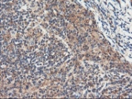 ab119780, at 1/150 dilution, staining RNPEP in paraffin-embedded Human lymphoma tissue by Immunohistochemistry.