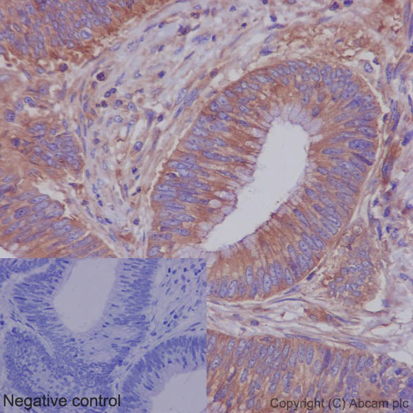 Immunohistochemistry (Formalin/PFA-fixed paraffin-embedded sections) analysis of human adenocarcinoma of the colon tissue labelling ROCK1 with purified ab45171 at 1/100. Heat mediated antigen retrieval was performed using Tris/EDTA buffer pH 9. A prediluted HRP-polymer conjugated anti-rabbit IgG was used as the secondary antibody. Negative control using PBS instead of primary antibody. Counterstained with hematoxylin.