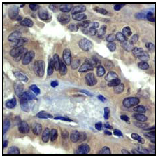Immunohistochemistry (Formalin/PFA-fixed paraffin-embedded sections) analysis of human thyroid gland carcinoma tissue labelling ROCK1 with unpurified ab45171.