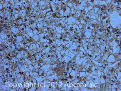 IHC image of ROCK2 staining in Human liver cancer formalin fixed paraffin embedded tissue section, performed on a Leica BondTM system using the standard protocol F. The section was pre-treated using heat mediated antigen retrieval with sodium citrate buffer (pH6, epitope retrieval solution 1) for 20 mins. The section was then incubated with ab71598, 5µg/ml, for 15 mins at room temperature and detected using an HRP conjugated compact polymer system. DAB was used as the chromogen. The section was then counterstained with haematoxylin and mounted with DPX.For other IHC staining systems (automated and non-automated) customers should optimize variable parameters such as antigen retrieval conditions, primary antibody concentration and antibody incubation times.