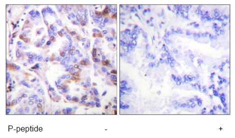 Immunohistochemistry analysis of paraffin-embedded human lung carcinoma tissue using ab61065 at 1/50-1/100 dilution with or without Phospho-peptide.