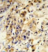 Immunohistochemical analysis of formalin-fixed, paraffin-embedded Human breast carcinoma tissue labelling RPGRIP1 with ab135832 at 1/50 dilution, followed by peroxidase-conjugated secondary antibody and DAB staining.