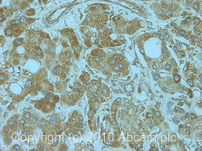 IHC image of RPL5 staining in human liver carcinoma formalin fixed paraffin embedded tissue section, performed on a Leica BondTM system using the standard protocol F. The section was pre-treated using heat mediated antigen retrieval with sodium citrate buffer (pH6, epitope retrieval solution 1) for 20 mins. The section was then incubated with ab86863, 1µg/ml, for 15 mins at room temperature and detected using an HRP conjugated compact polymer system. DAB was used as the chromogen. The section was then counterstained with haematoxylin and mounted with DPX.