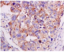 Immunohistochemical analysis of paraffin embedded Human hepatocellular carcinoma tissue labeling RPL7A with ab172478 at 1/50 dilution.