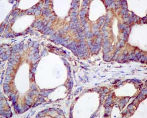 Immunohistochemical analysis of paraffin-embedded Human colonic adenocarcinoma tissue labeling RPS19 with ab181365 at 1/100 dilution.