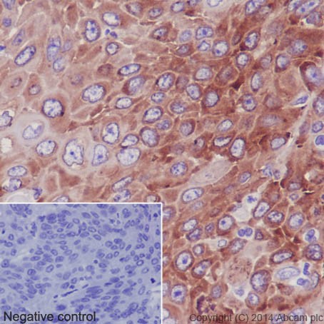 Immunohistochemical analysis of paraffin-embedded Human squamous cell carcinoma of cervix tissue labeling RPS24 with ab196652 at 1/100 dilution followed by Goat Anti-Rabbit IgG H&L (HRP) (ab97051) secondary antibody at 1/500 dilution. Cytoplasm staining on Human squamous cell carcinoma of cervix tissue is observed. Counter stained with Hematoxylin.
