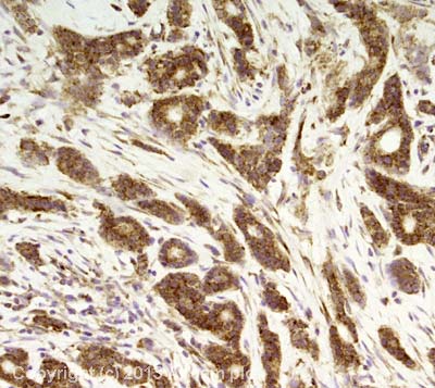 IHC image of RPS7 staining in human breast adenocarcinoma formalin fixed paraffin embedded tissue section, performed on a Leica Bond system using the standard protocol F. The section was pre-treated using heat mediated antigen retrieval with sodium citrate buffer (pH6, epitope retrieval solution 1) for 20 mins. The section was then incubated with ab57637, 5µg/ml, for 15 mins at room temperature and detected using an HRP conjugated compact polymer system. DAB was used as the chromogen. The section was then counterstained with haematoxylin and mounted with DPX.For other IHC staining systems (automated and non-automated) customers should optimize variable parameters such as antigen retrieval conditions, primary antibody concentration and antibody incubation times.