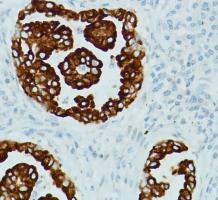 Immunohistochemical analysis of paraffin embedded Human lung adenocarcinoma tissue labelling RRM1 with ab135383 antibody at a dilution of 1/100.