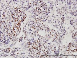 RRP9 antibody (ab56460) used in immunohistochemistry at 3ug/ml on formalin fixed and paraffin embedded human ovary, clear cell carcinoma.