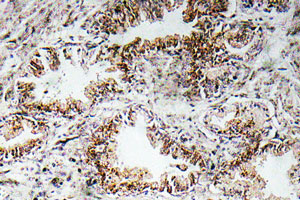Immunohistochemical analysis of paraffin embedded Human prostate carcinoma tissue labelling Nicotinic Acetylcholine Receptor alpha 1 with ab135272 at 1/50.