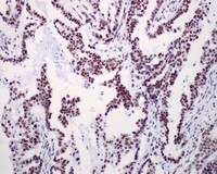 ab109002 at 1/250 dilution, staining RSF1 in Human endometrial adenocarcinoma by Immunohistochemistry, Paraffin-embedded tissue.