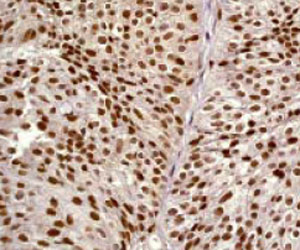 ab32062 at a 1:250 - 1:500 dilution staining Rsk 2 / MAPKAP Kinase 1b in human urinary bladder carcinoma, using Immunohistochemistry, Paraffin Embedded Tissue.